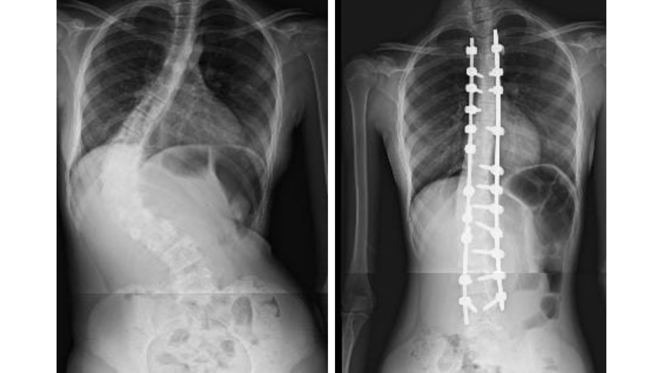 Realizada a primeira cirurgia de escoliose na cidade de Três Pontas